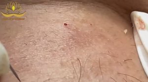 Профессиональное очищение кожи от закрытых комедонов Anna #007