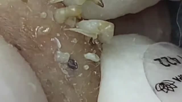 Asmr. Убирание угрей с кожи лица 𝐖𝐢𝐧 #𝟏𝟐𝟒𝟖