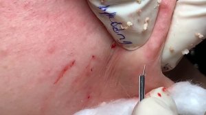 Лечение закрытых комедонов для девушки #067 Hương