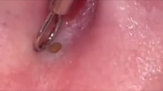 #29 Чистка лица от угрей и акне. Выдавливание прыщей. Удаление черных точек и комедонов