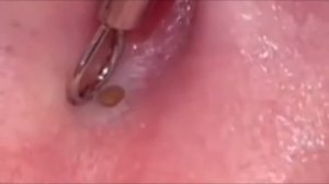 Чистка лица от угрей и акне. Выдавливание прыщей. Удаление черных точек и комедонов