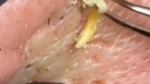 Чистка лица от угрей и акне. Выдавливание прыщей. Удаление черных точек и комедонов