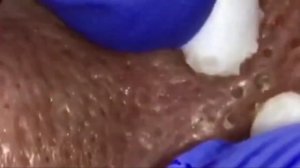 Чистка лица от угрей и акне. Выдавливание прыщей. Удаление черных точек и комедонов