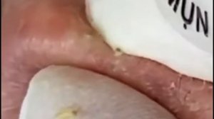 Чистка лица от угрей и акне. Выдавливание прыщей. Удаление черных точек и комедонов