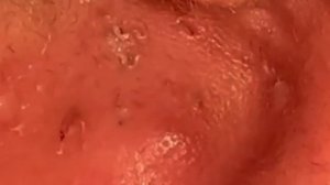 Чистка лица от угрей и акне. Выдавливание прыщей. Удаление черных точек и комедонов