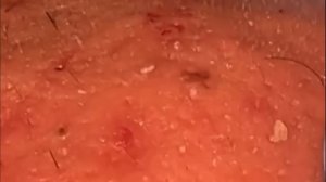 Чистка лица от угрей и акне. Выдавливание прыщей. Удаление черных точек и комедонов