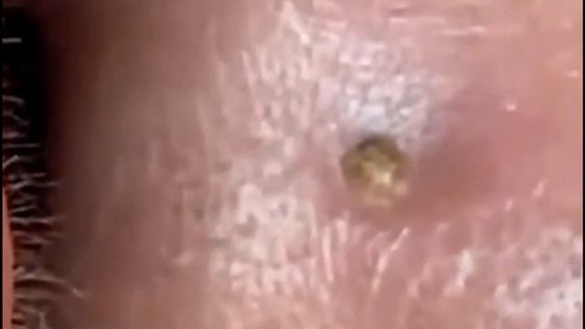 #28 Чистка лица от угрей и акне. Выдавливание прыщей. Удаление черных точек и комедонов