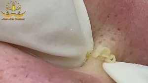 Asmr. Удаление прыщей и белых точек Anna #006