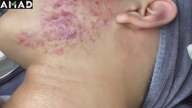 Asmr. Очищение лица от огромных прыщей #500383