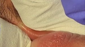 Чистка лица от угрей и акне. Выдавливание прыщей. Удаление черных точек и комедонов