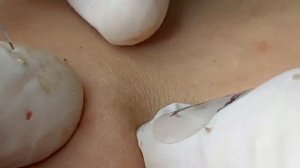 Очищение пор от черных точек - SDS#194