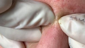 Asmr. Процедура лечения акне. Nang #051