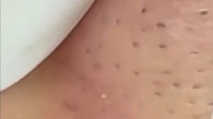 Чистка лица от угрей и акне. Выдавливание прыщей. Удаление черных точек и комедонов