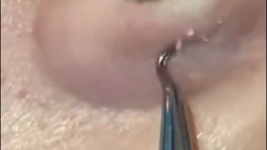 Чистка лица от угрей и акне. Выдавливание прыщей. Удаление черных точек и комедонов