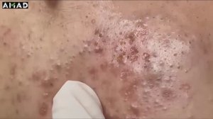 Чистим лицо от прыщей и черных точек: процедура у косметолога #50063