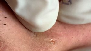 Удаление прыщей. Очень приятно смотреть #026 Hương