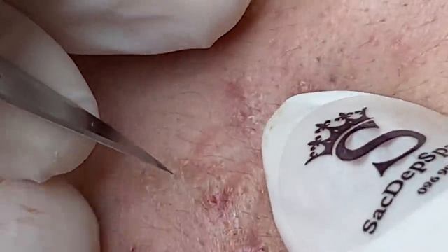 Лечение подкожных прыщей на лице - SDS#177