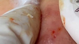 Чистка лица от глубоких черных точек.