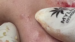 Выдавливание черных точек. Правильная техника. Linh #112