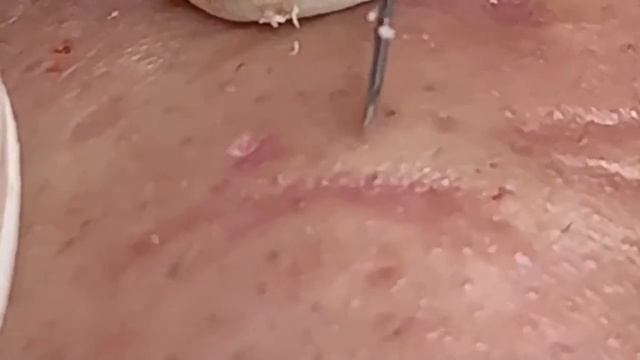 Лечим угри на лице: Удаление акне. Hari # 010