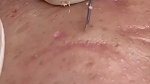 Лечим угри на лице: Удаление акне. Hari # 010