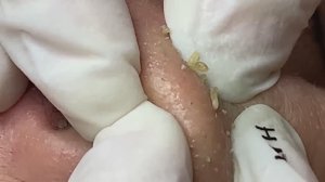 Механическая чистка пор носа #Hoang09