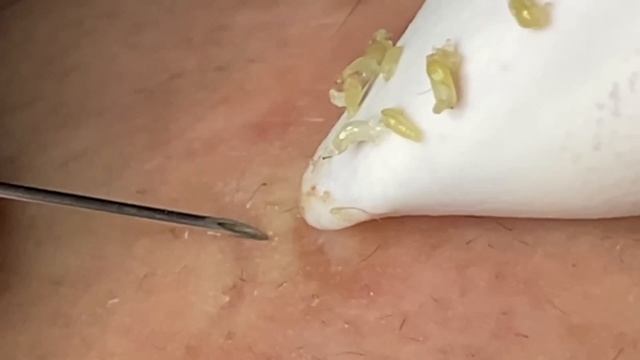 Asmr. Механическое очищение от акне и белых точек.