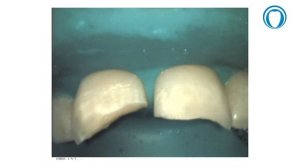 Восстановление передних зубов Коба Светлана Николаевна