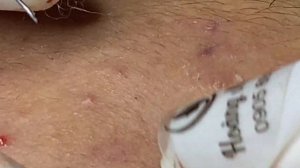 Воспалительные акне в зоне нижней челюсти, гормональные высыпания #Hoang12