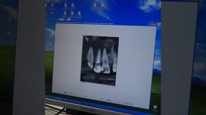 Успешное лечение кисты зуба в клинике Ладент