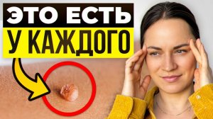 ПАПИЛЛОМЫ ОТПАДУТ САМИ! Это главный признак, что внутри вас вирус