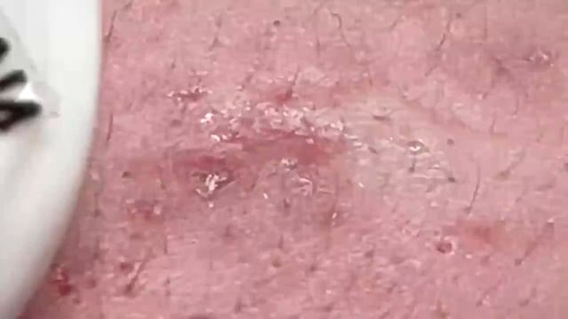 Чистим кожу от белых точек (закрытых комедонов) Hari # 060