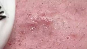 Чистим кожу от белых точек (закрытых комедонов) Hari # 060