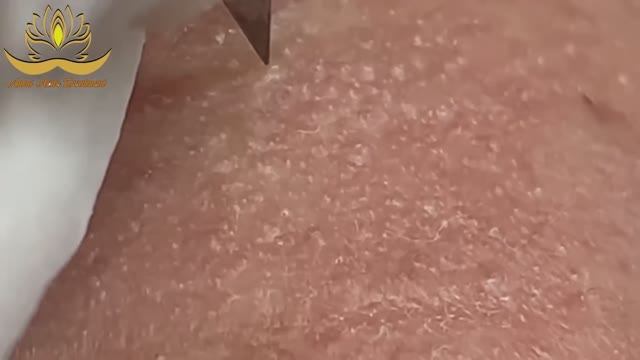 Профессиональное удаление акне и милиумов. Anna #008