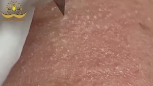 Профессиональное удаление акне и милиумов. Anna #008