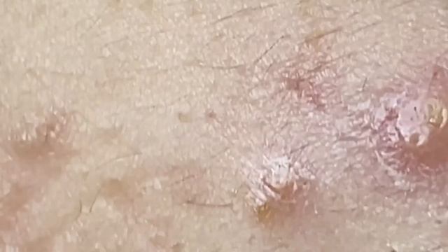 Asmr. Чистим лицо от угрей.