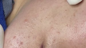 Гормональное акне в зоне подбородка #Hoang11