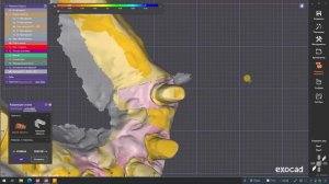 Меняем культю в сделанной реставрации ExoCad