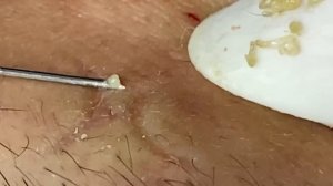 Процедуры для лечения акне в спа-центре