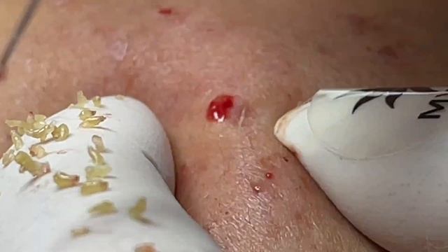 Выдавливание угревой сыпи. Профессиональное избавление Linh #108