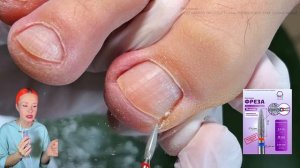 обработка вросшего ногтя, подногтевых мозолей и установка титановой нити, но такого композита