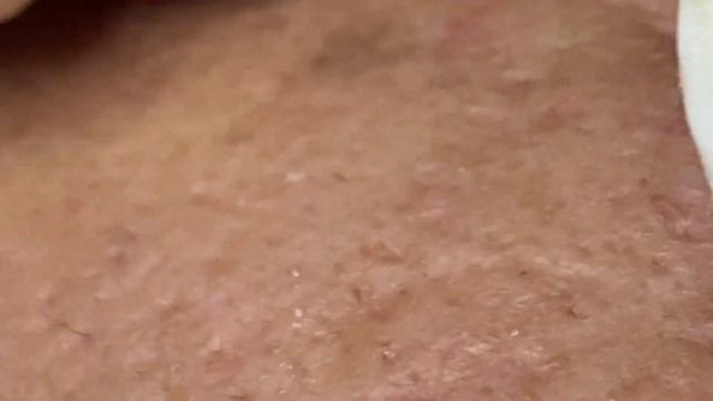 Воспалившаяся киста ушной раковины #Hoang08