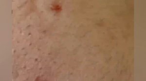 Выдавливание прыщей, угрей, черных точек и камедонов #253