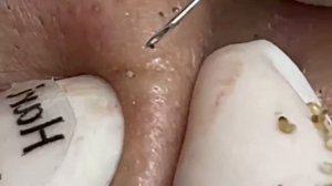 Asmr. Лечим угрей. Hari # 012