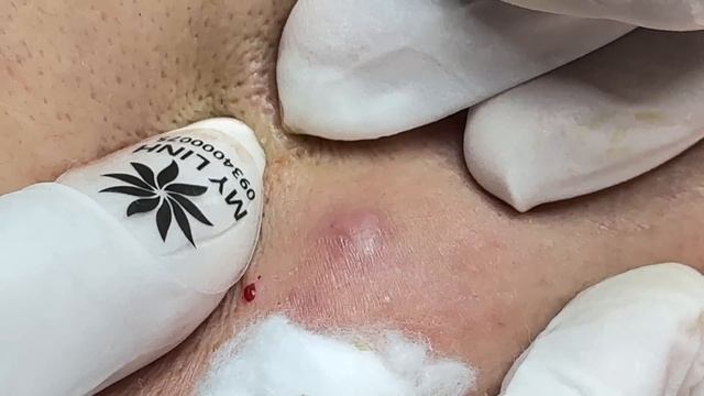 Удаление белых точек на лице у косметолога Linh #612 смотреть онлайн