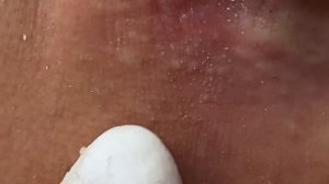 Избавление от сальных нитей на носу #Hoang10