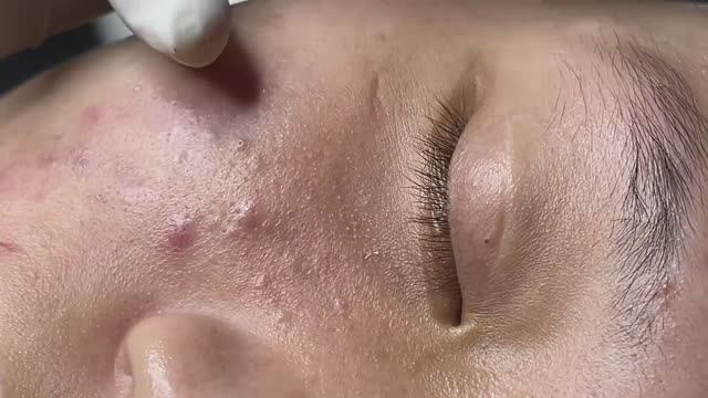 Профессиональное очищение от угревой сыпи Linh #111