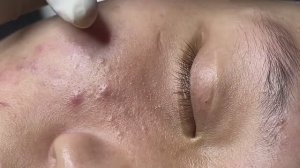 Профессиональное очищение от угревой сыпи Linh #111