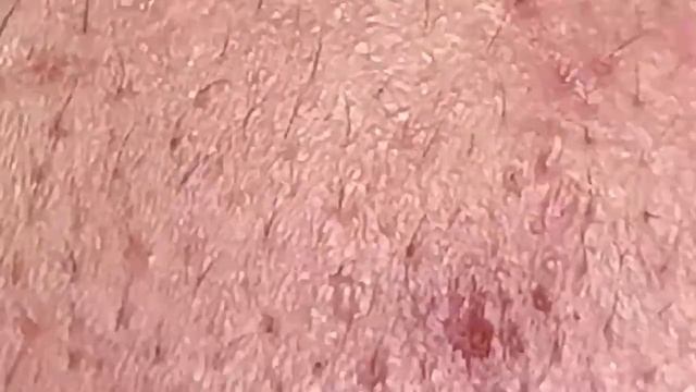 Профессиональное удаление белых точек (милиумов) иглой Hari # 011