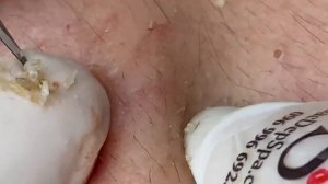 Выдавливание прыщей, угрей, черных точек и камедонов #254